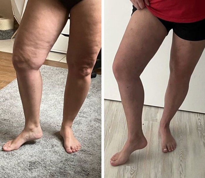 lipedema-antes-e-depois07-1.jpg