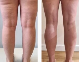 lipedema-antes-e-depois08-1.jpg