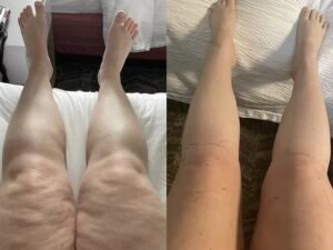 lipedema-antes-e-depois10.jpg