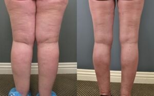 lipedema-antes-e-depois19.jpg